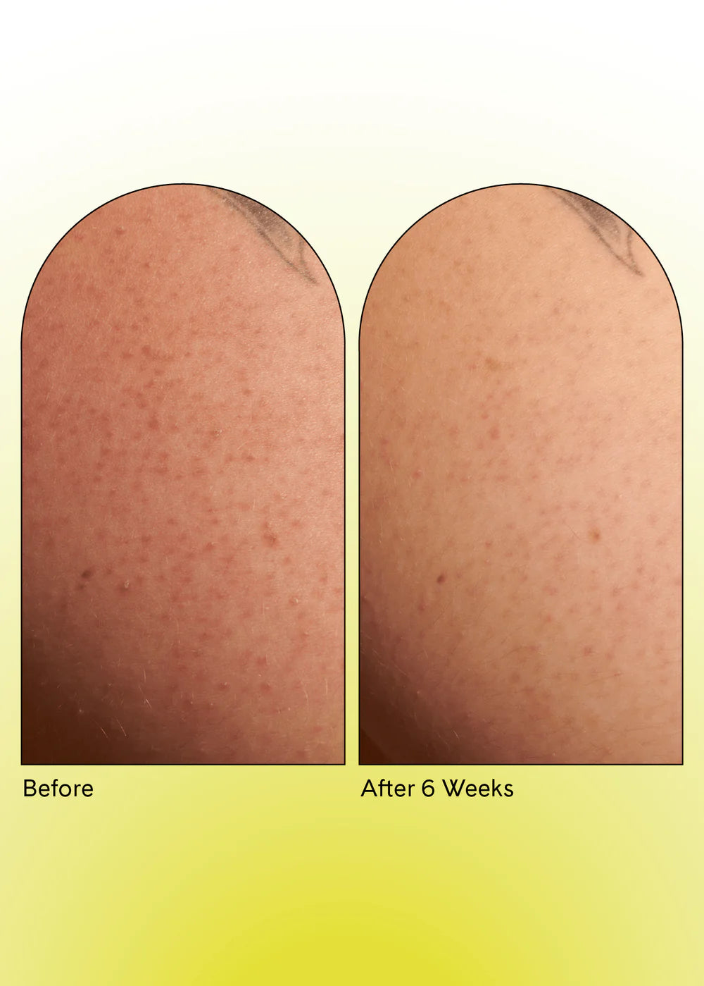 Keratosis Pilaris Body Scrub